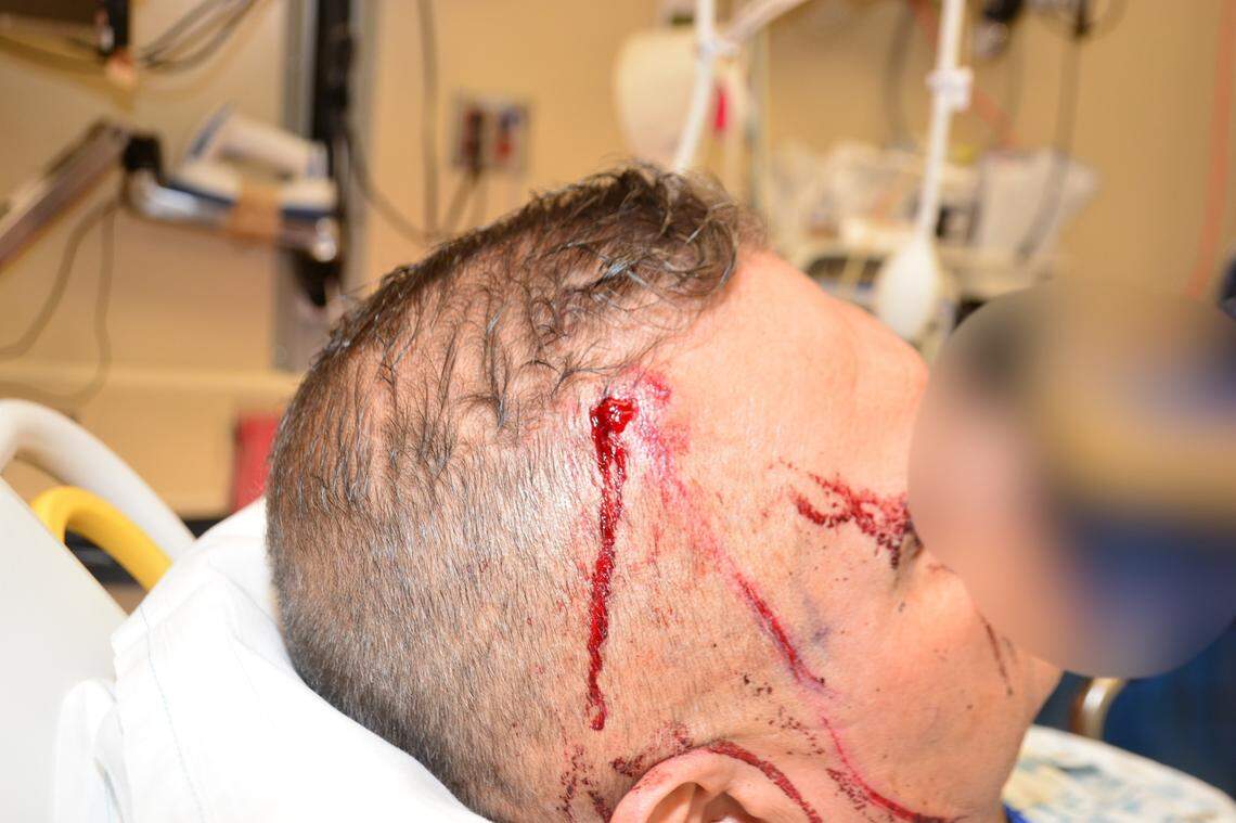 Fresno police on Wednesday, March 30, 2022, released photos of the injuries a detective suffered during an attack in his office the previous day, according to police.