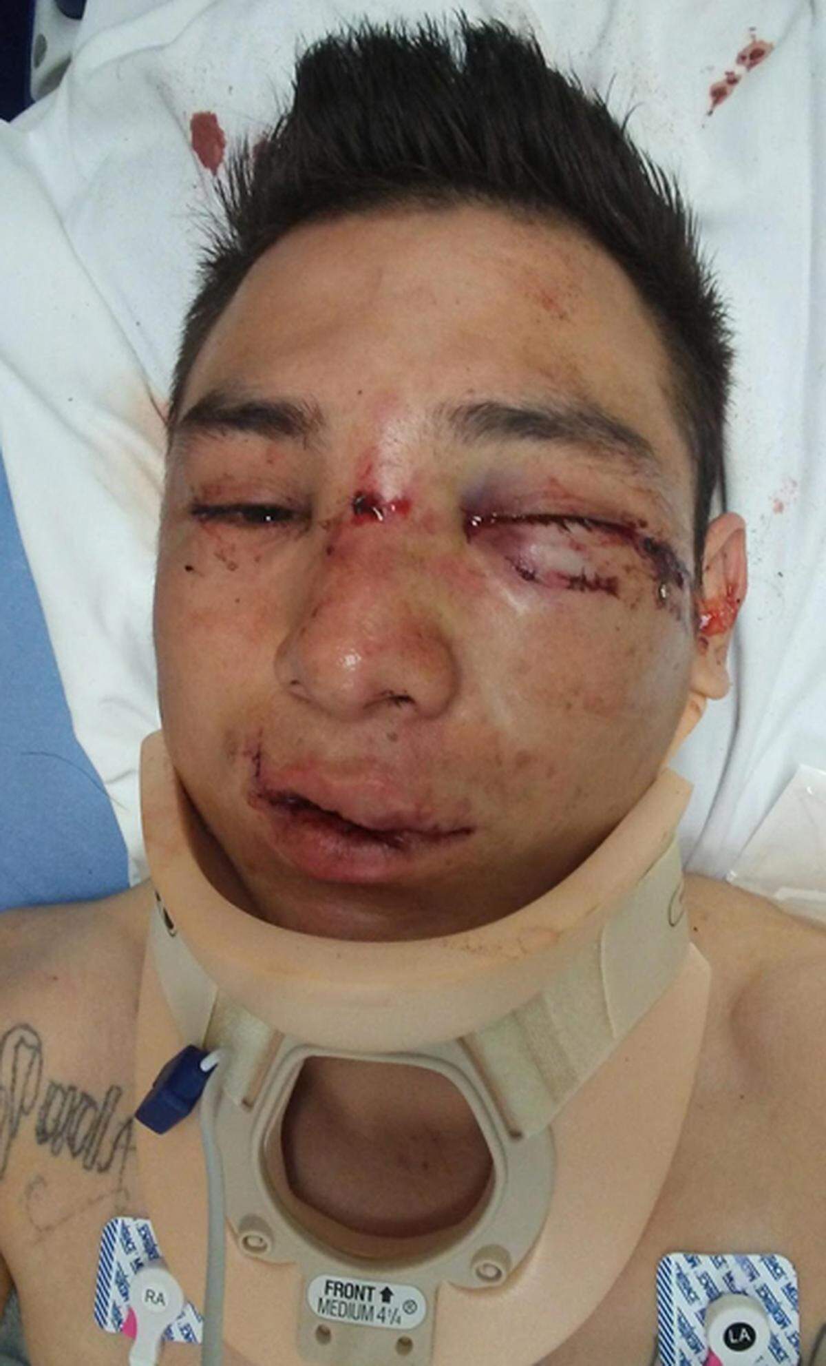 Omar Hernandez Huerta shortly after he was attacked June 10, 2017.