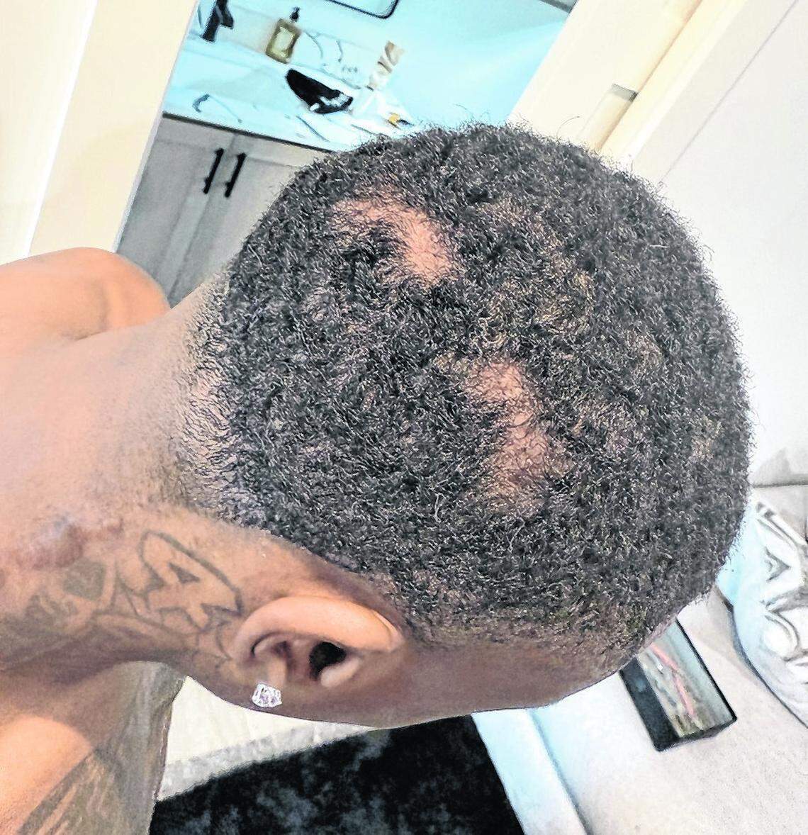 Xavier Worthy’s lawsuit against former fiancée Tia Jones included this photograph that allegedly depicts bald spots on Worthy’s head that resulted after Jones tore out portions of his hair. A Fresno native who plays wide receiver for the Kansas City Chiefs, Worthy has been portrayed in headlines as both a serial domestic abuser and victim of abuse.