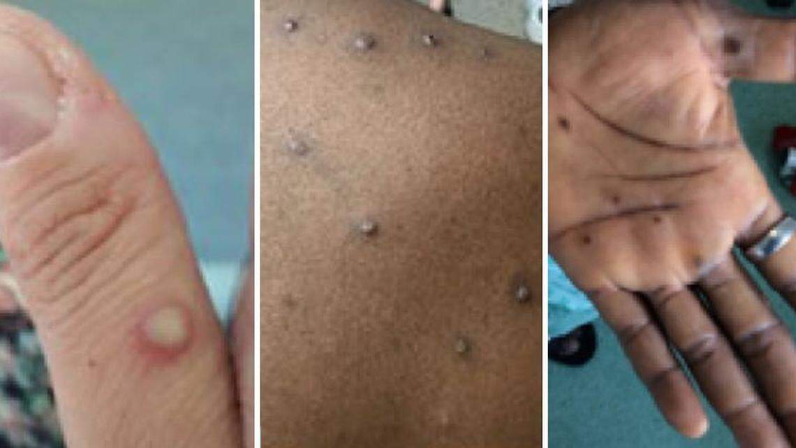 Photos show examples of what the monkeypox rash or lesions can look like on an infected person.