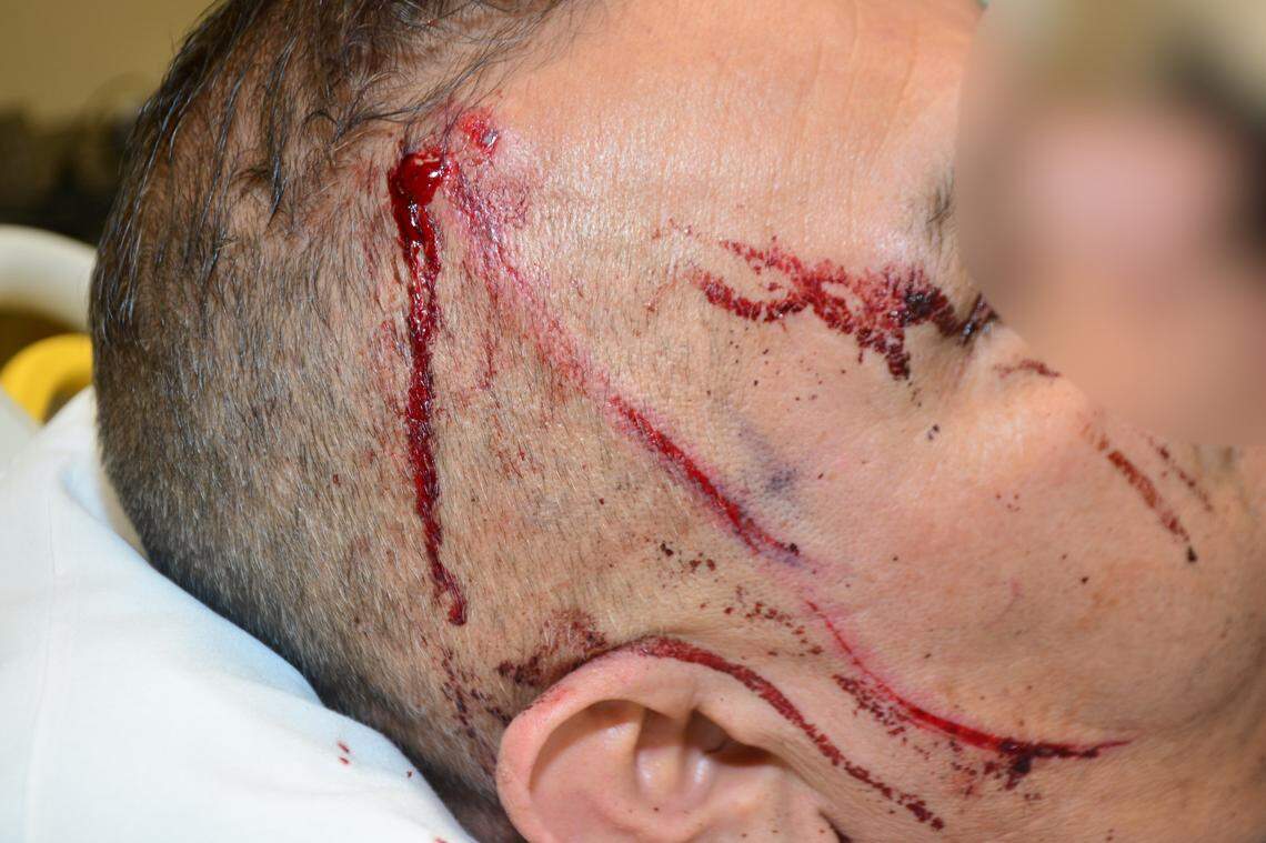 Fresno police on Wednesday, March 30, 2022, released photos of the injuries a detective suffered during an attack in his office the previous day, according to police.