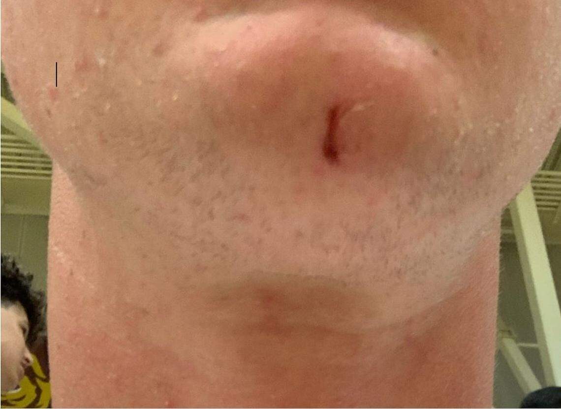 A former Clovis West High School boys water polo player is suing CUSD and a coach. He alleges she threw a marker pen at him and cut his chin.