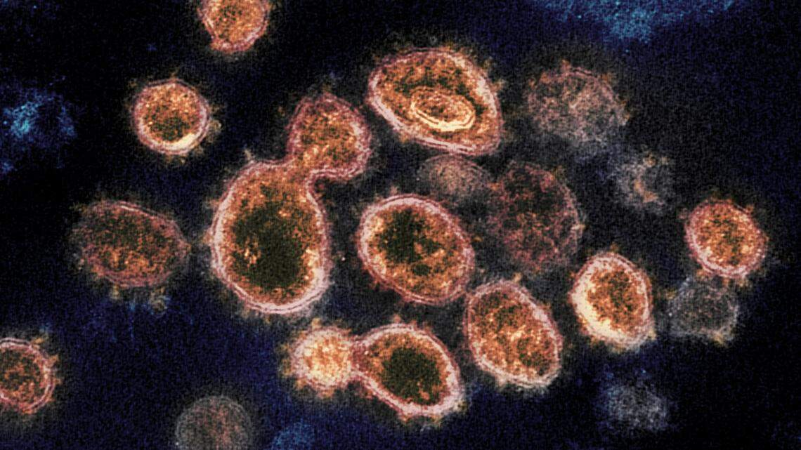 This 2020 electron microscope image provided by the National Institute of Allergy and Infectious Diseases - Rocky Mountain Laboratories shows SARS-CoV-2 virus particles which causes COVID-19, isolated from a patient in the U.S., emerging from the surface of cells cultured in a lab. Coronaviruses, including the newest one, are named for the spikes that cover their outer surface like a crown, or corona in Latin. Using those club-shaped spikes, the virus latches on to the outer wall of a human cell, invades it and replicates, creating viruses to hijack more cells. (NIAID-RML via AP)