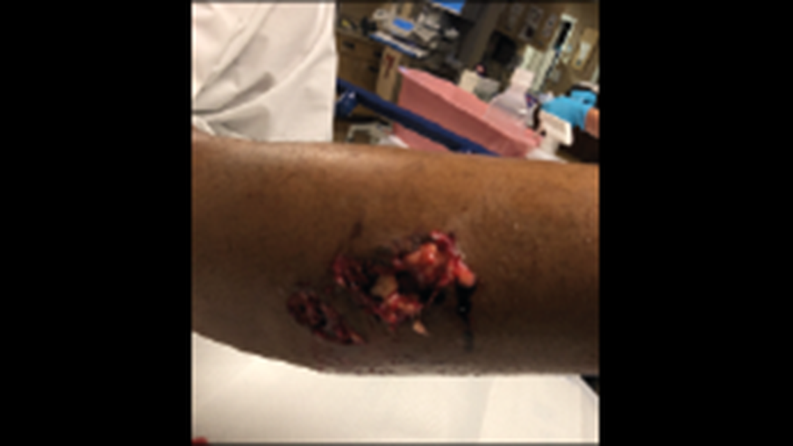 Jamal Jones says he is suing the City of Clovis after being left with permanent injures from a police dog bite.