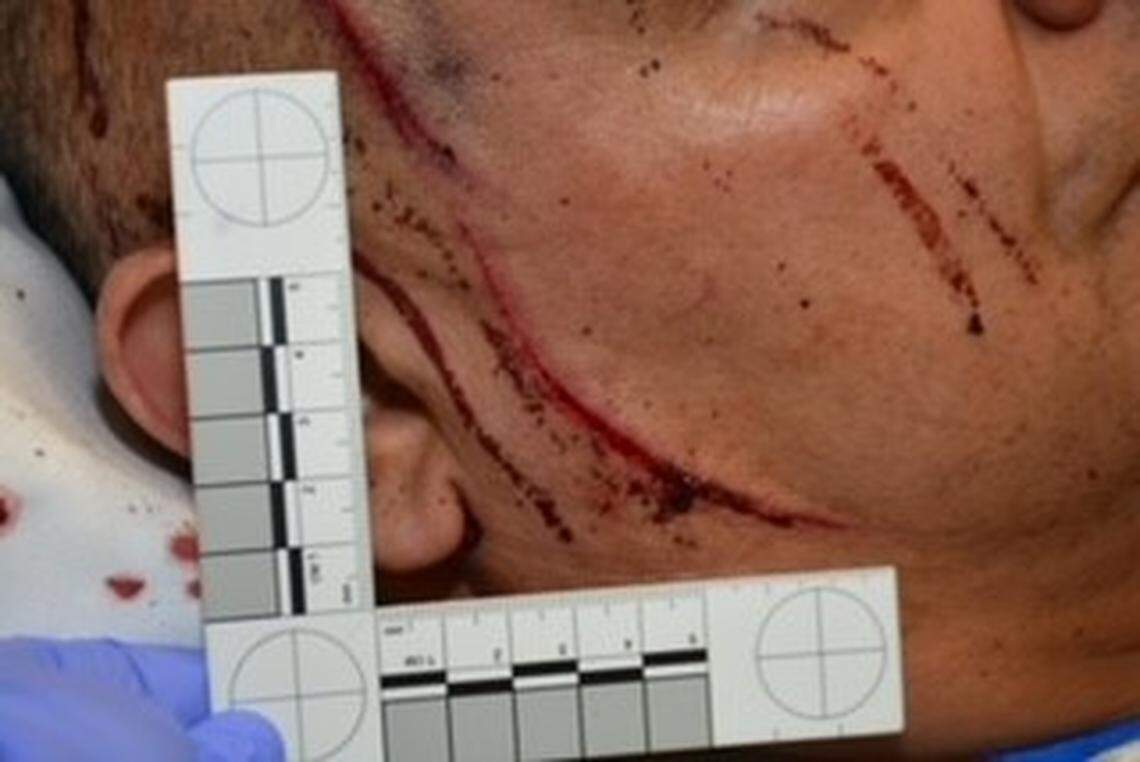 Fresno police on Wednesday, March 30, 2022, released photos of the injuries a detective suffered during an attack in his office the previous day, according to police.