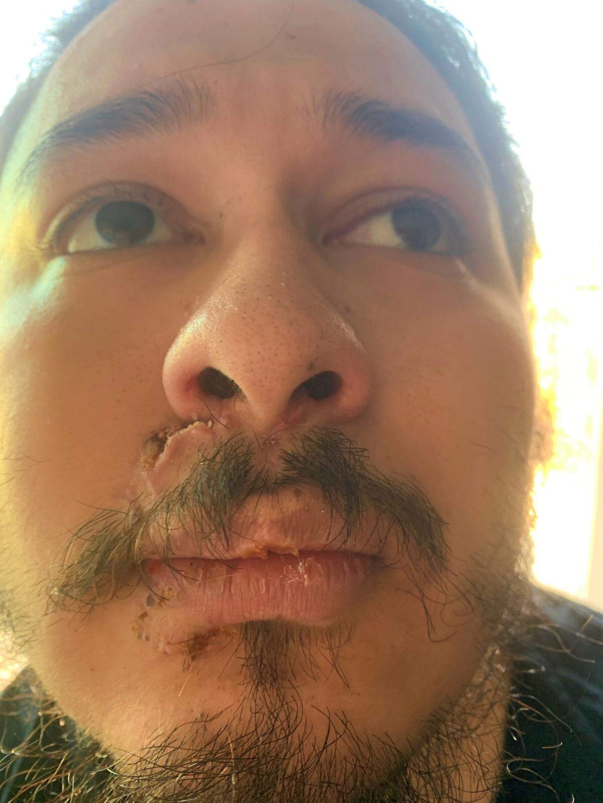 Jordan Gutierrez, now 22, who is diagnosed as paranoid schizophrenic with psychosis, was bitten by a K-9 canine on the face in October 2020 when his mother called police for help because her son was having a mental crisis.