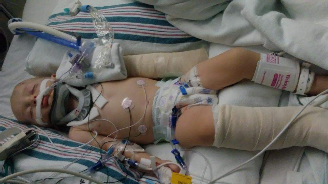 One-year-old David Broderick is seen at Valley Children’s Hospital in Madera County in a photo shared by his mother, Jennifer Mestas. David is being treated for multiple injuries including a broken leg, broken arm and severe brain trauma.