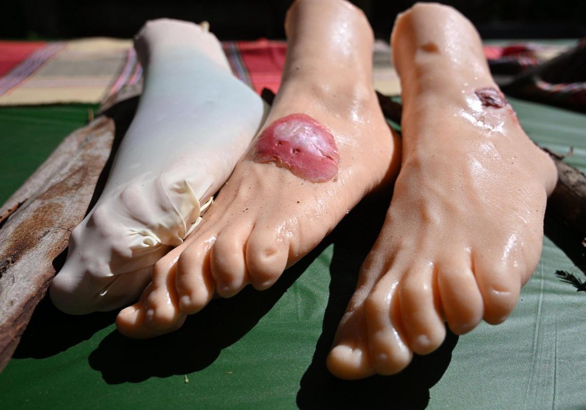 Simulated stages of a rattlesnake bite are displayed during an exhibition outlining precautions for rattlesnake encounters held at the Fresno Chaffee Zoo Friday. March 22, 2024 in Fresno.