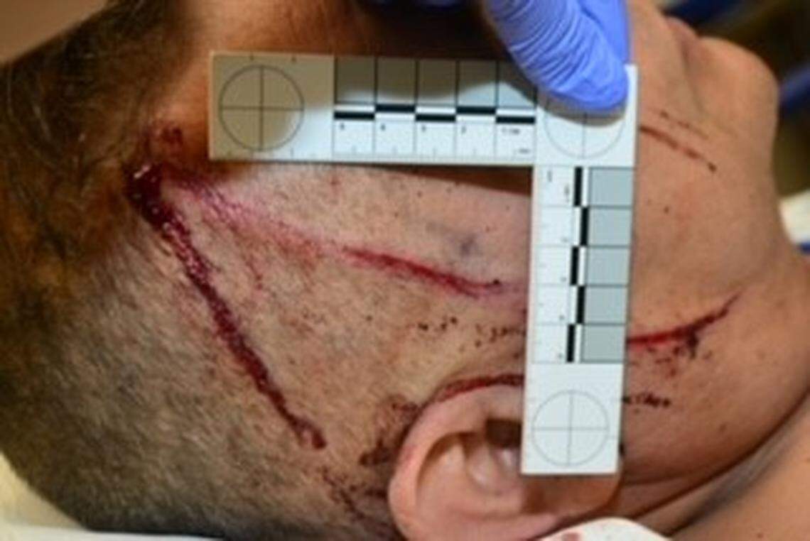 Fresno police on Wednesday, March 30, 2022, released photos of the injuries a detective suffered during an attack in his office the previous day, according to police.