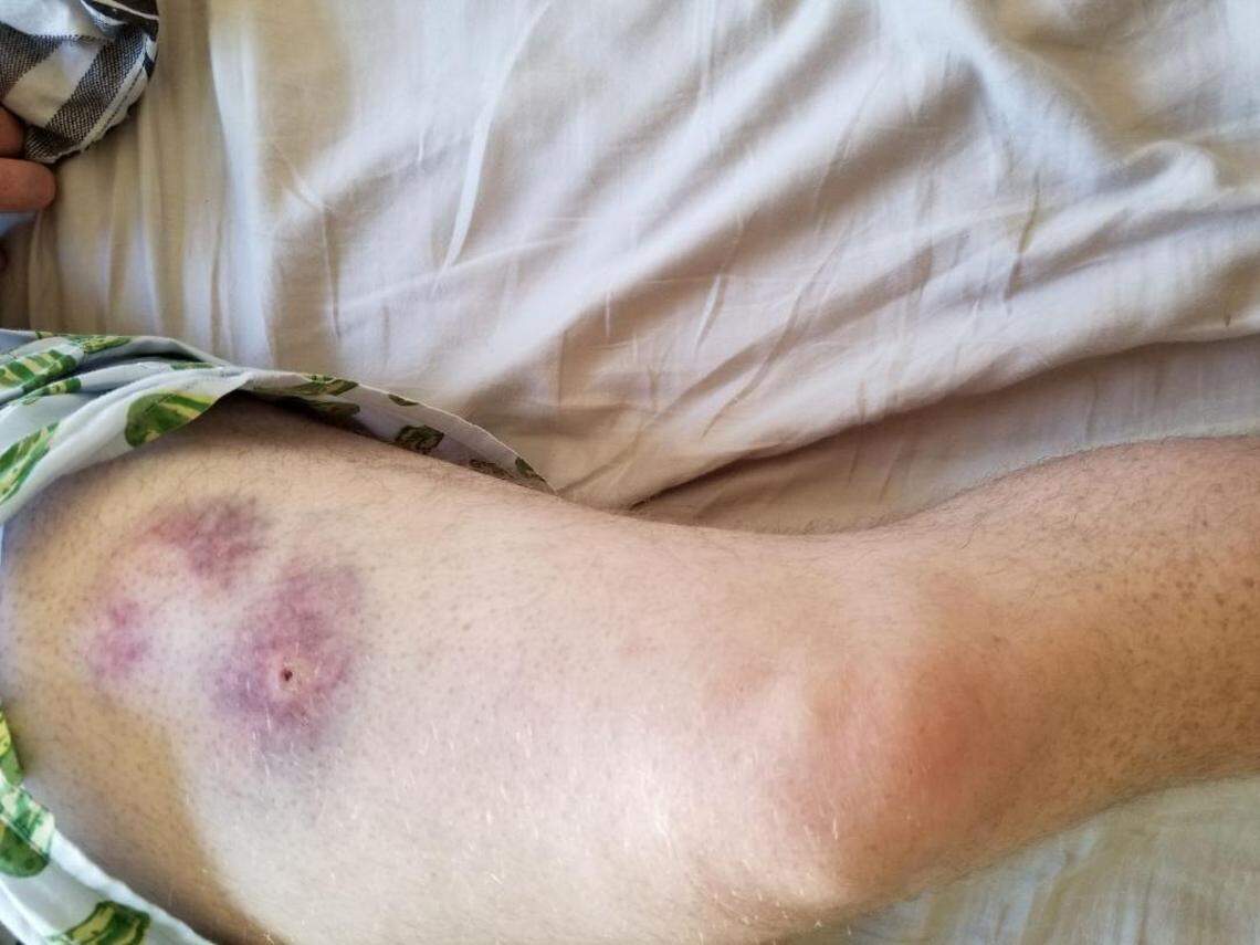 Jay Tucker suffered a puncture wound from a dog bite in late August near his home on Fountain Way.