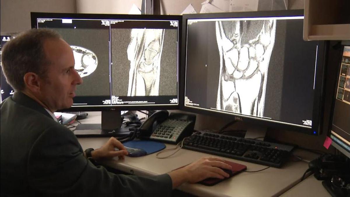 UC Davis radiology professor Dr. Robert Boutin and a colleague studied the sounds and effects of knuckle cracking.