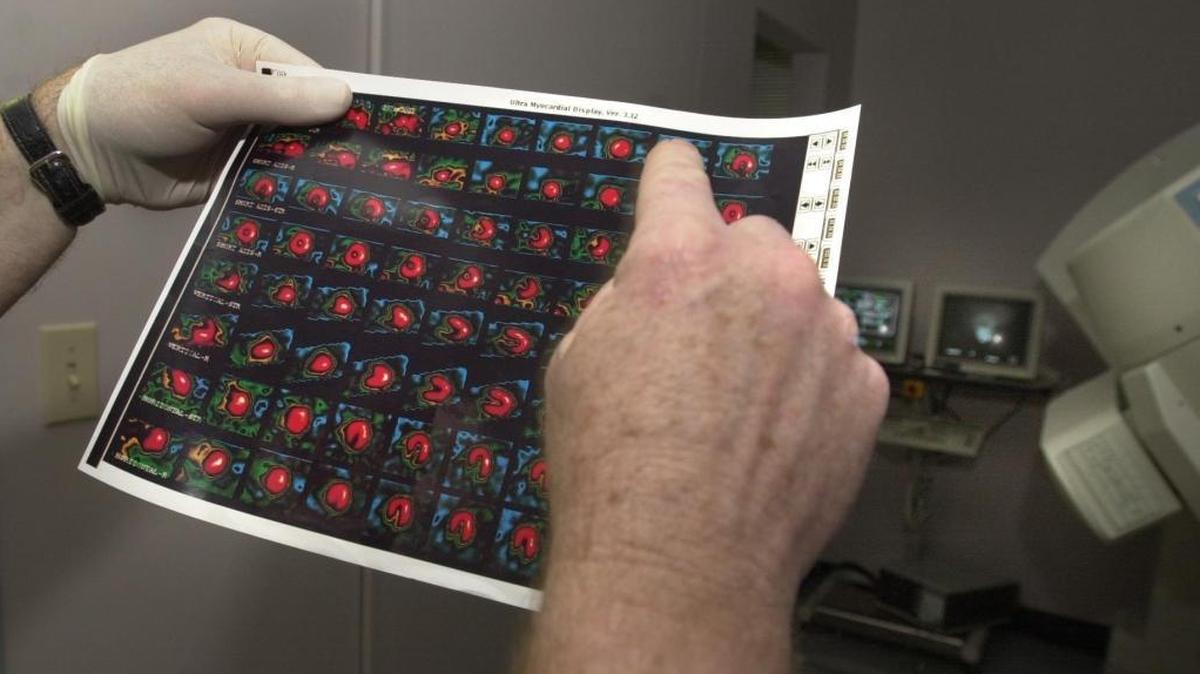 An example of the results made from a nuclear stress test that a heart doctor reviews.