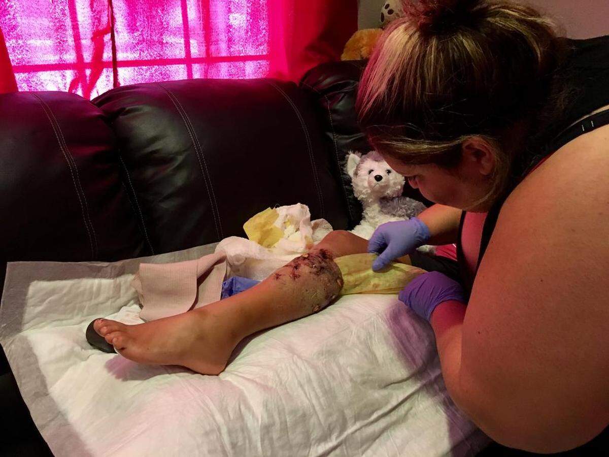 Valerie Morales cleans the leg of her 10-year-old daughter, Andinaye Godinez, who was mauled by a friend’s pit bull in Fresno on Sunday, July 15, 2018.