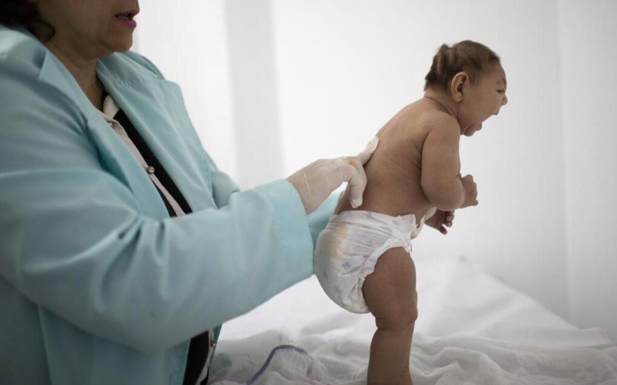 In this Feb. 12, 2016 photo, Lara, who is less then 3-months old and was born with microcephaly, is examined by a neurologist at the Pedro I hospital in Campina Grande, Paraiba state, Brazil. Zika virus during a mother’s pregnancy causes the microcephaly birth defect and other brain abnormalities.