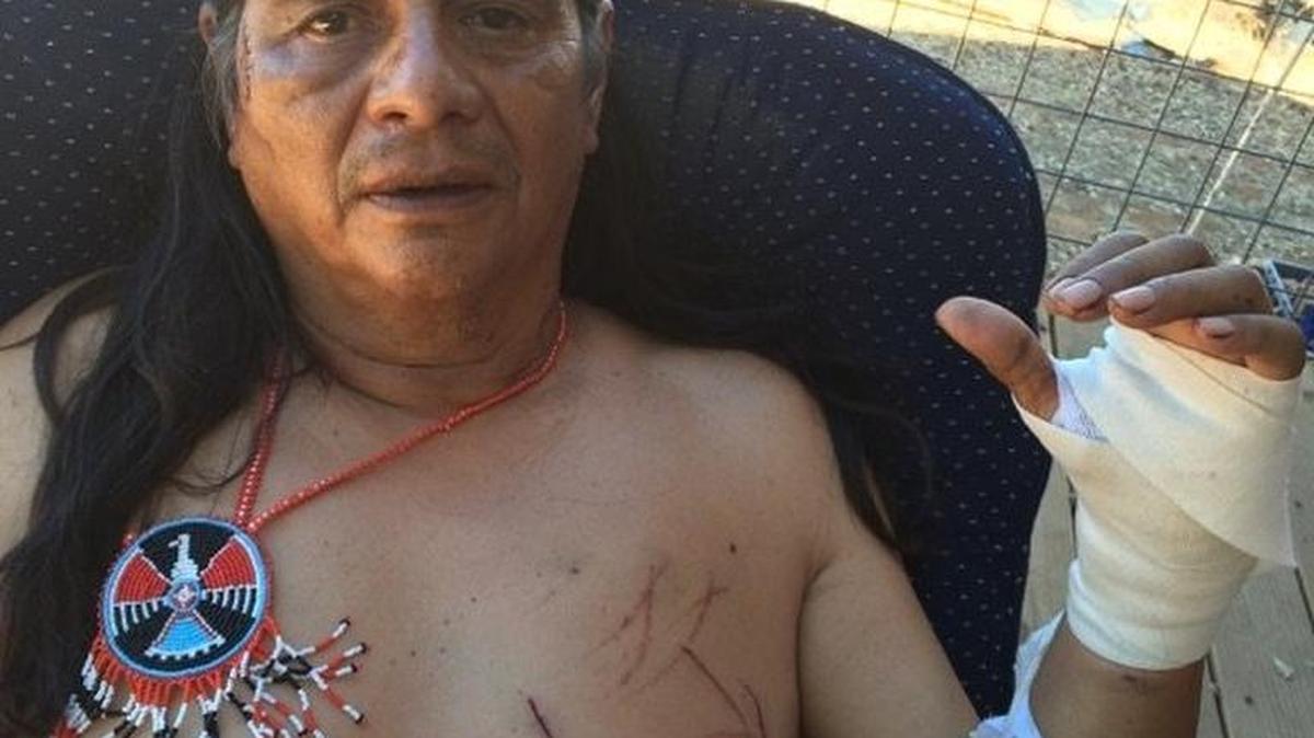 
Larry Yepez shows his injuries from the bear attack.
