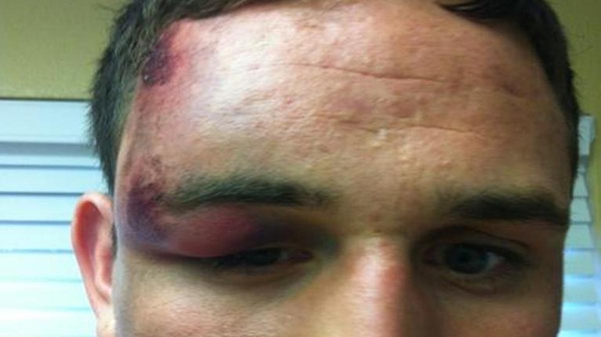 A federal civil rights lawsuit accuses four Clovis police officers of beating then-20-year-old George Macias Jr. and using a stun gun on him in September 2012. Police accused Macias of resisting arrest, but a jury in 2014 found him not guilty of the charge. This photo provided by Macias’ lawyer Charles Tony Piccuta shows what he says are injuries Macias suffered during the September 2012 arrest.