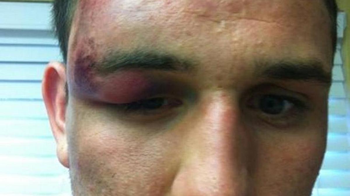 George Macias Jr., 24, says four Clovis police officers savagely beat him while he was handcuffed and used a stun gun on him in September 2012. His lawyers released a photo that they say shows the injuries Macias suffered.