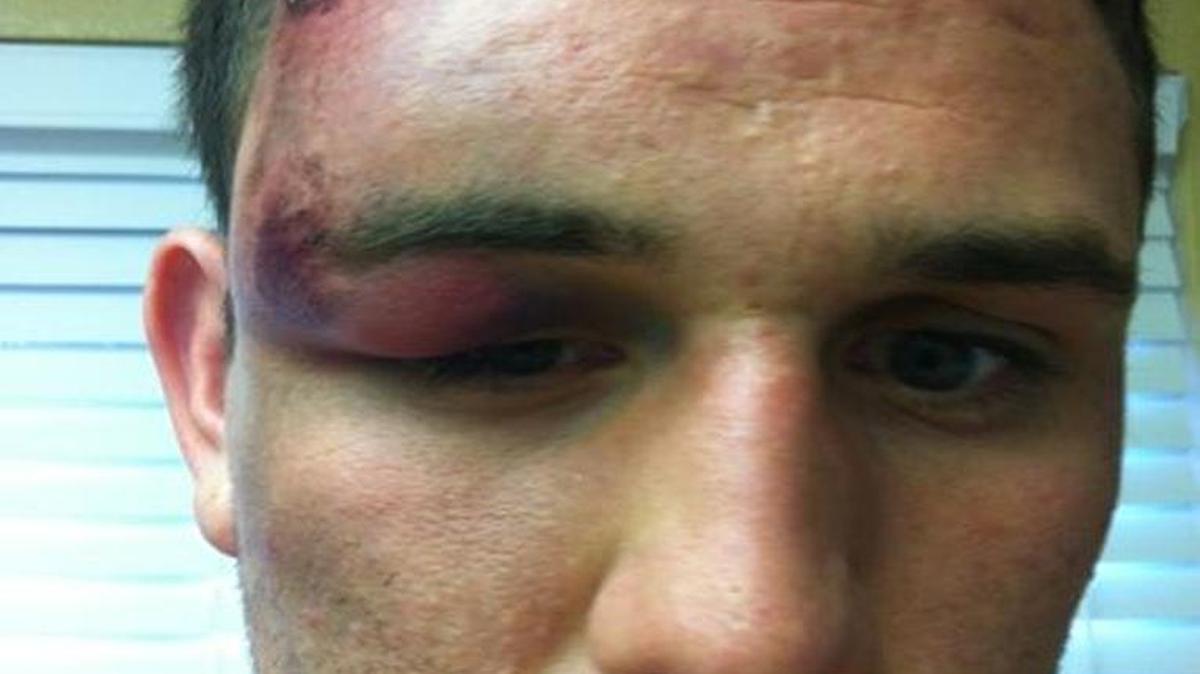 George Macias Jr., 24, says four Clovis police officers savagely beat him while he was handcuffed and used a stun gun on him in September 2012. His lawyers released a photo that they say shows the injuries Macias suffered.