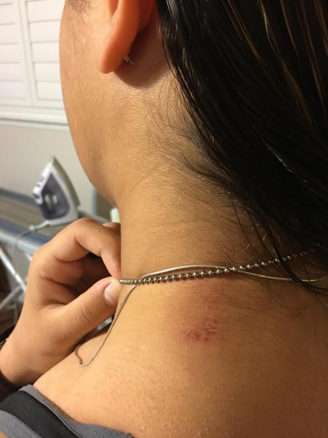 An abrasion on Logann Pruneda’s neck that she says is from being pelted with a juice box by a fellow student, who also shouted gay slurs at her on Monday at Bullard High.