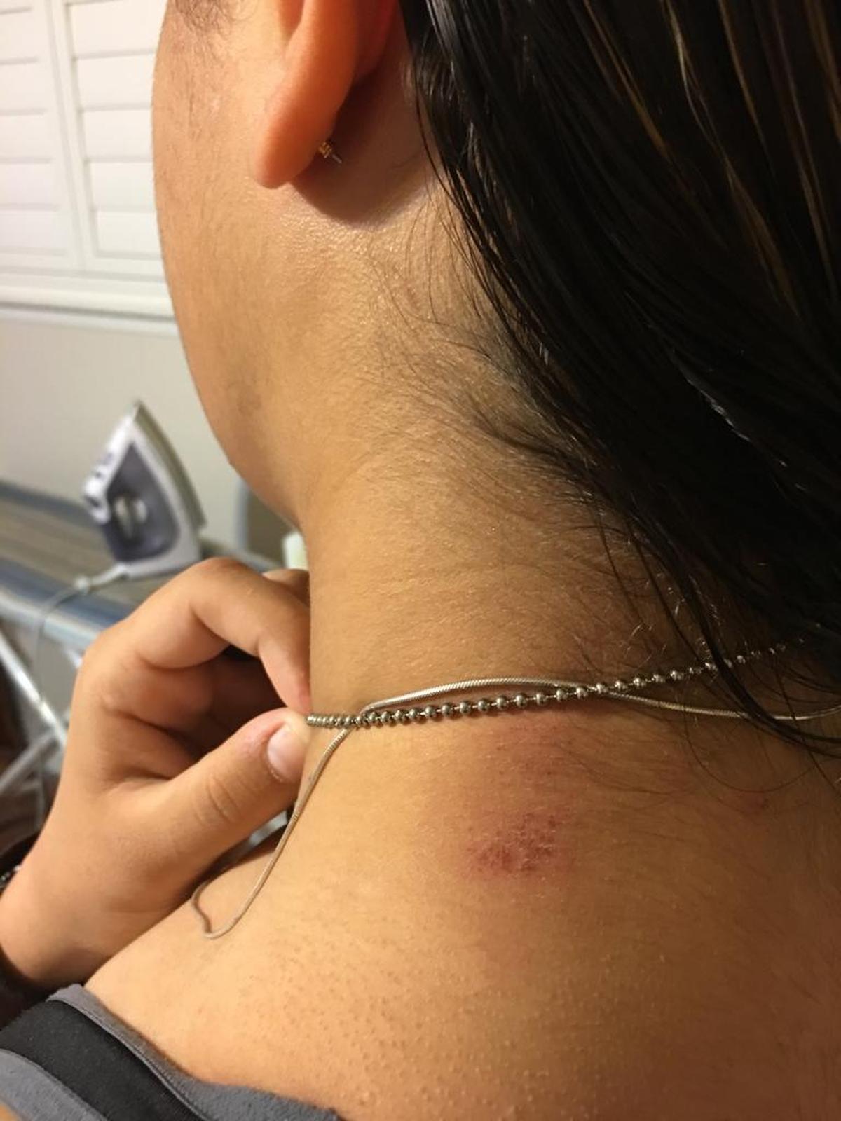 An abrasion on Logann Pruneda’s neck that she says is from being pelted with a juice box by a fellow student, who also shouted gay slurs at her on Monday at Bullard High.
