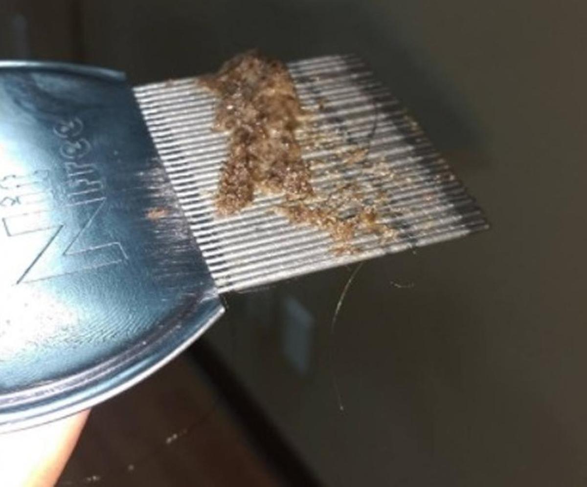 An example of lice and nits combed from hair.