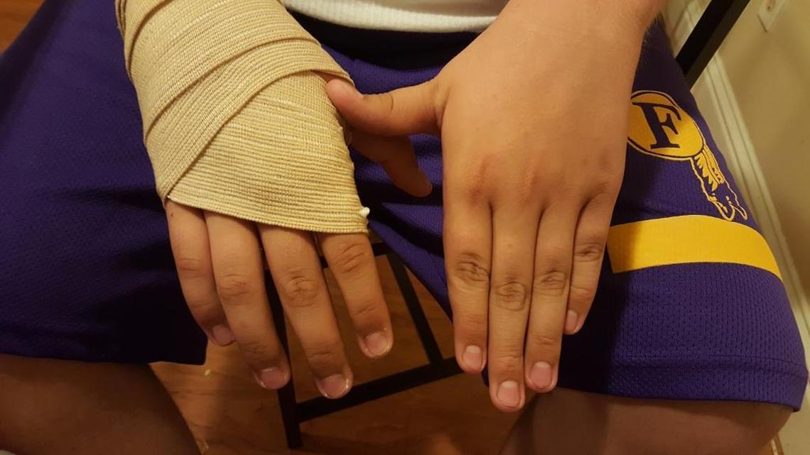 Dominic Elliott’s right hand was wrapped after sheriff’s deputies pulled him over and handcuffed him while he was a student driver in Drive America’s training car in April 2016.