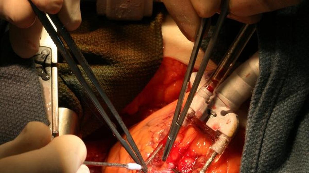 A state report on heart bypass surgeries done in 2014 says Community Regional Medical Center in Fresno was one of two hospitals in California to rate worse than average for deaths.