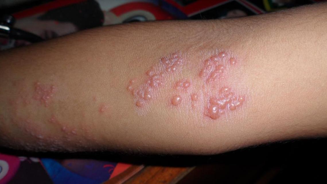 Shingles is the rash and blisters caused by the chickenpox virus reactivating inside a person’s body, typically in seniors.
